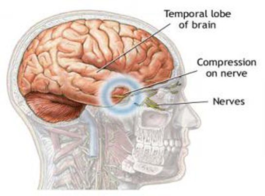 Beyincik Damar Tıkanıklığı Belirtileri ve Tedavisi
